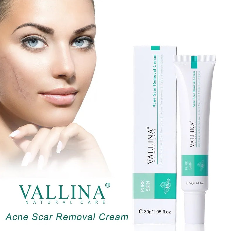 VALLINA Acne Scar Removal Cream for Men & women, 1 oz